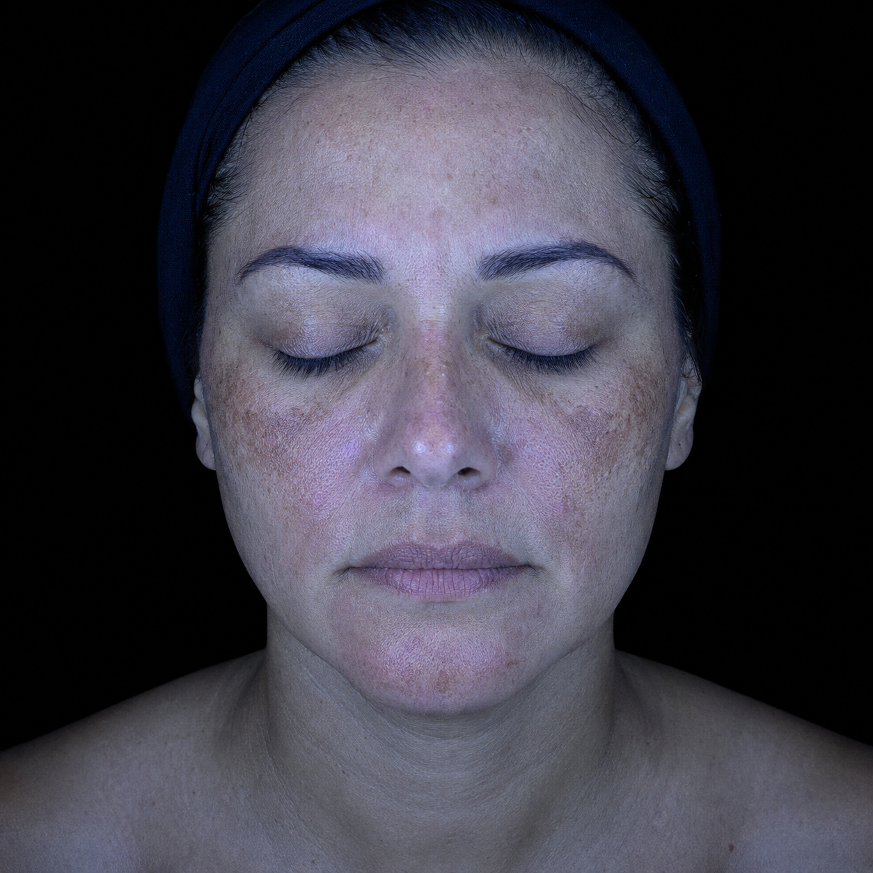 Observ 520x pigmentation mapping